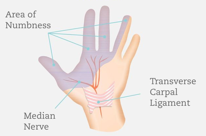 手部腕管綜合徵麻木區 