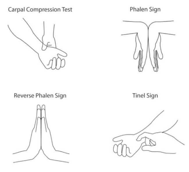 腕管綜合徵的 tinle 徵
